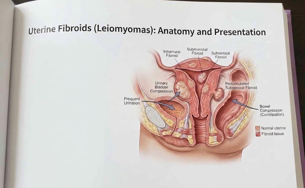 uterine fibroid